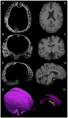 Volumetric MRI Analysis of a Case of Severe Ventriculomegaly
